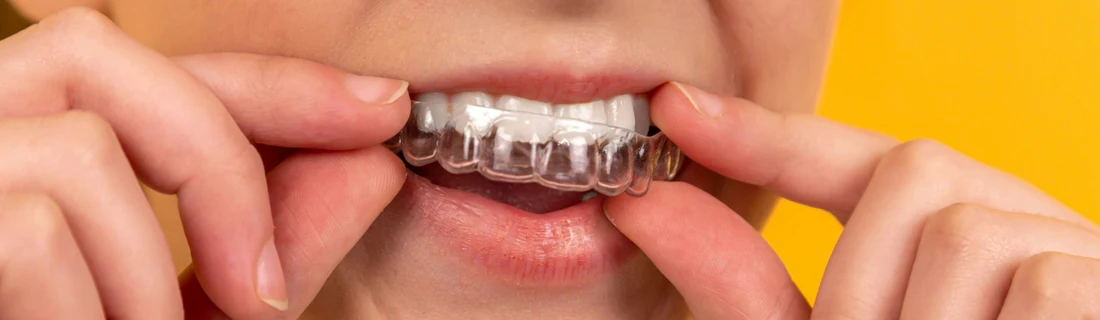 Dentist Tuscaloosa AL Invisalign Focused close up of a woman's mouth while she is removing or putting in her invisalign braces